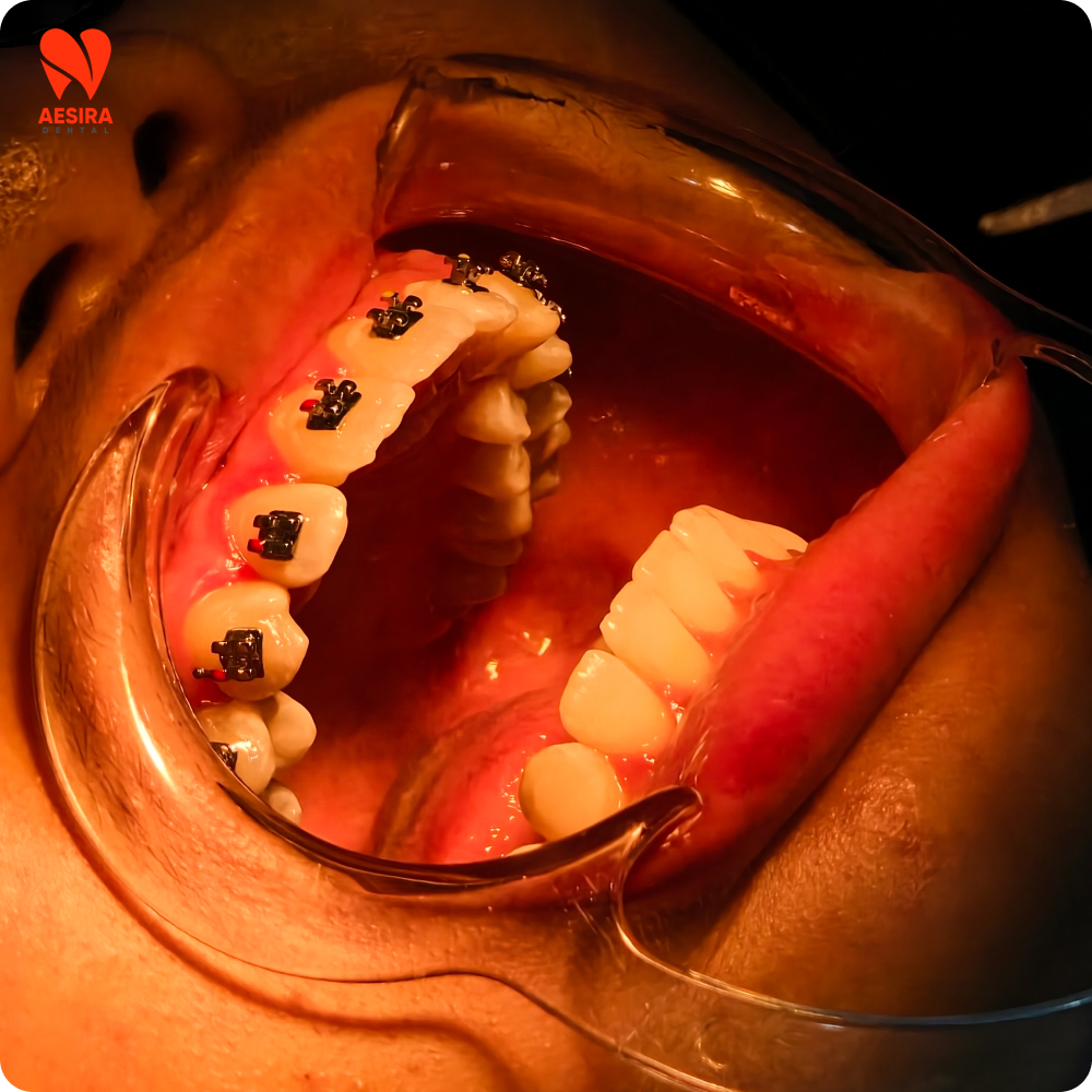pasang braces konvensional kajang