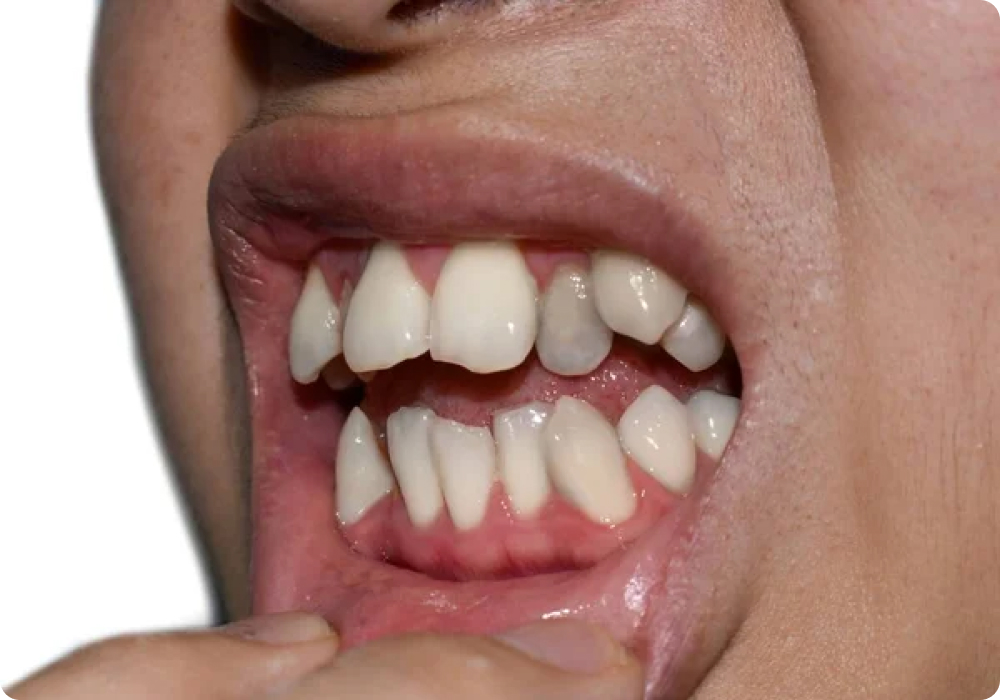 gigi bertindih pasang braces klinik gigi kajang