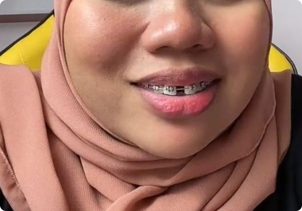 gigi jarang 