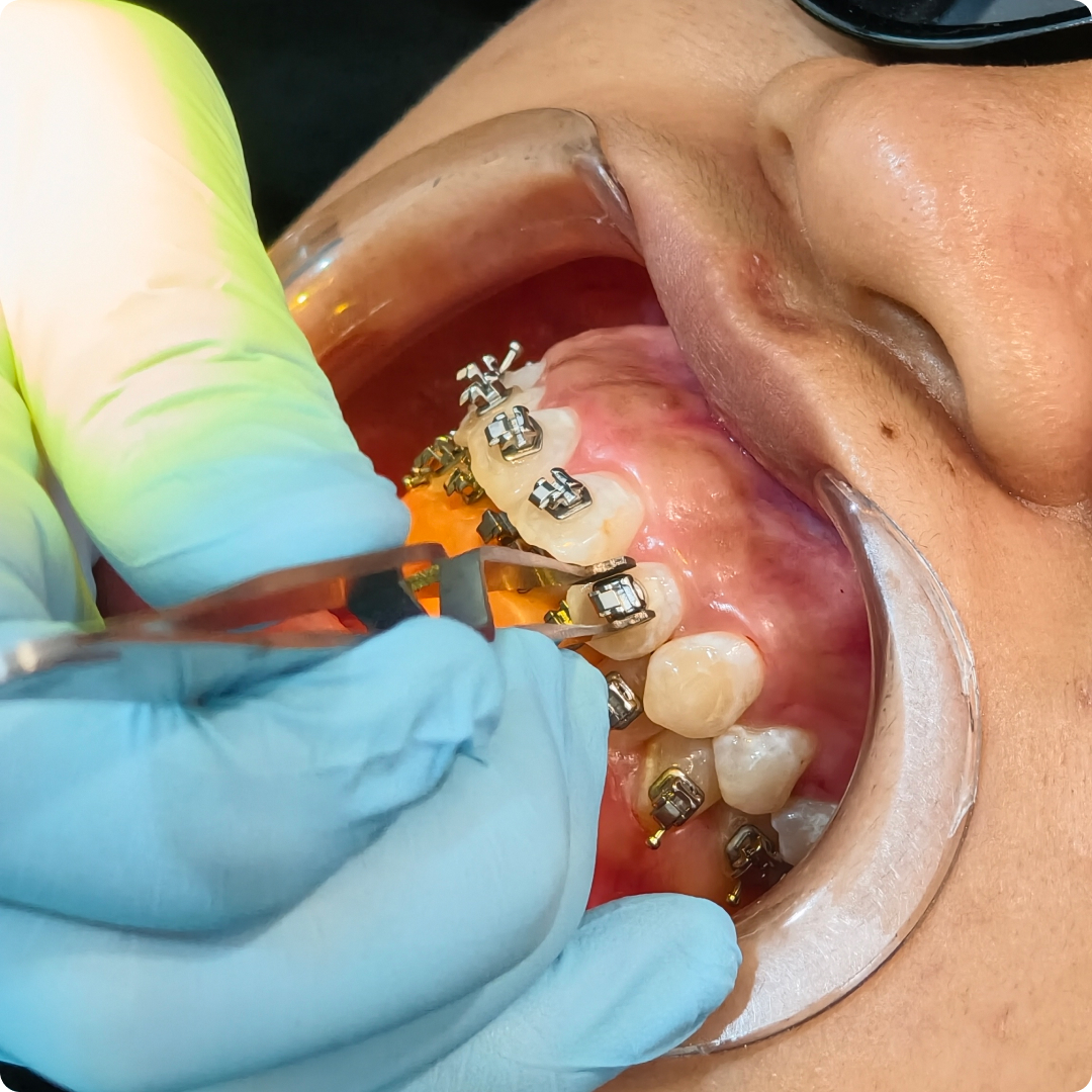 pasang metal braces