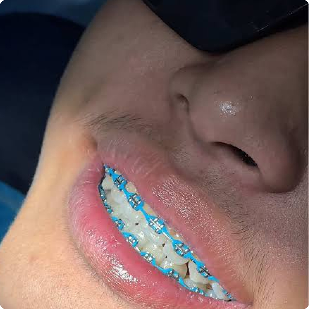 pilihan braces warna warni