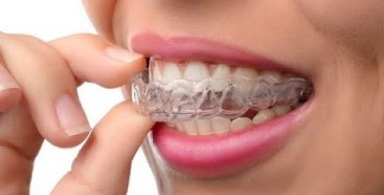 clear aligner kajang
