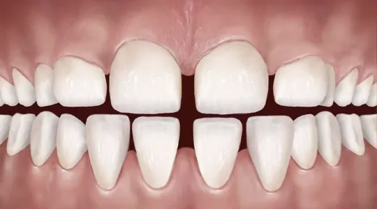 gigi jarang aesira dental