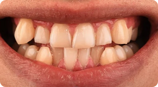 pasang clear aligner gigi aesira dental kajang