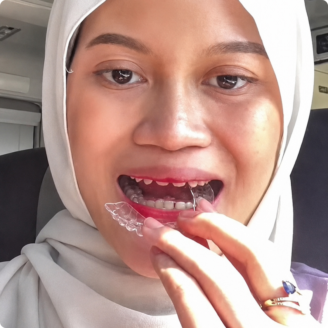 perbezaan aligner dan braces