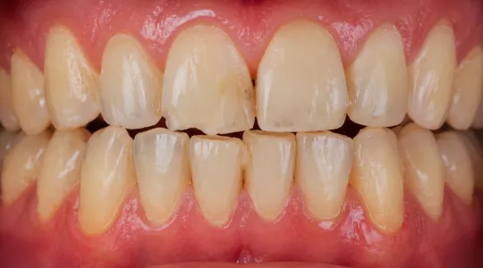 sebelum veneer