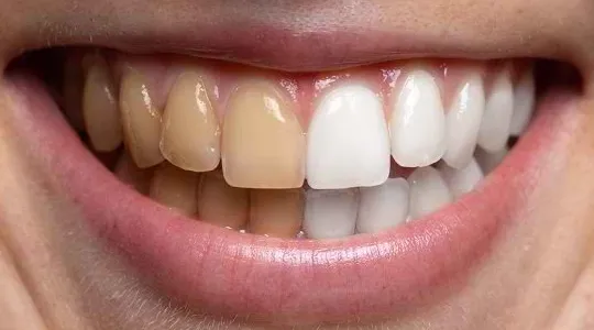 warna gigi tak sekata