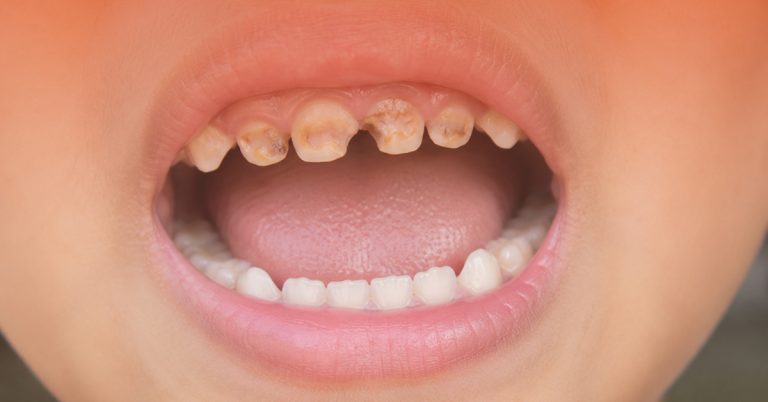 Gigi Kanak-Kanak Rosak: Simptom & Rawatan di Aesira Dental