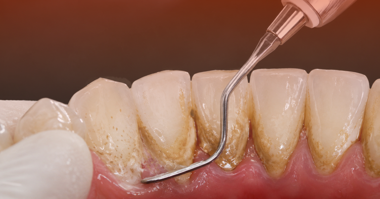 Karang Gigi: Punca, Simptom & Rawatan di Aesira Dental