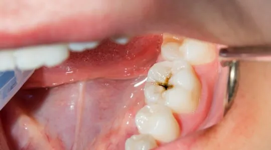 masalah karies gigi klinik pergigian kajang bangi aesira dental