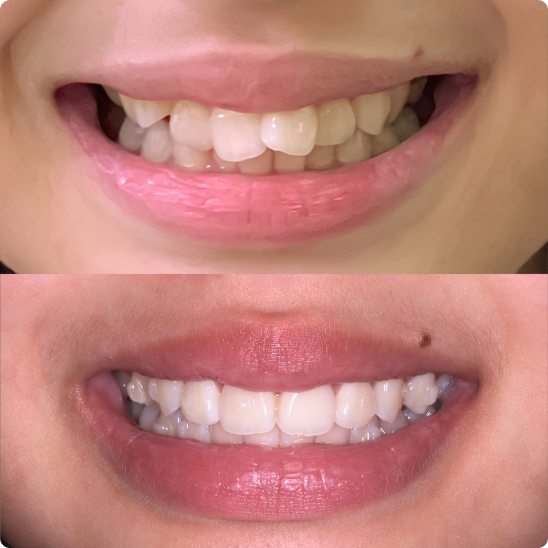 rawatan clear aligner sebelum selepas