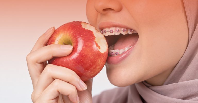 5 Berus Gigi Braces Terbaik di Malaysia (Saranan Doktor)