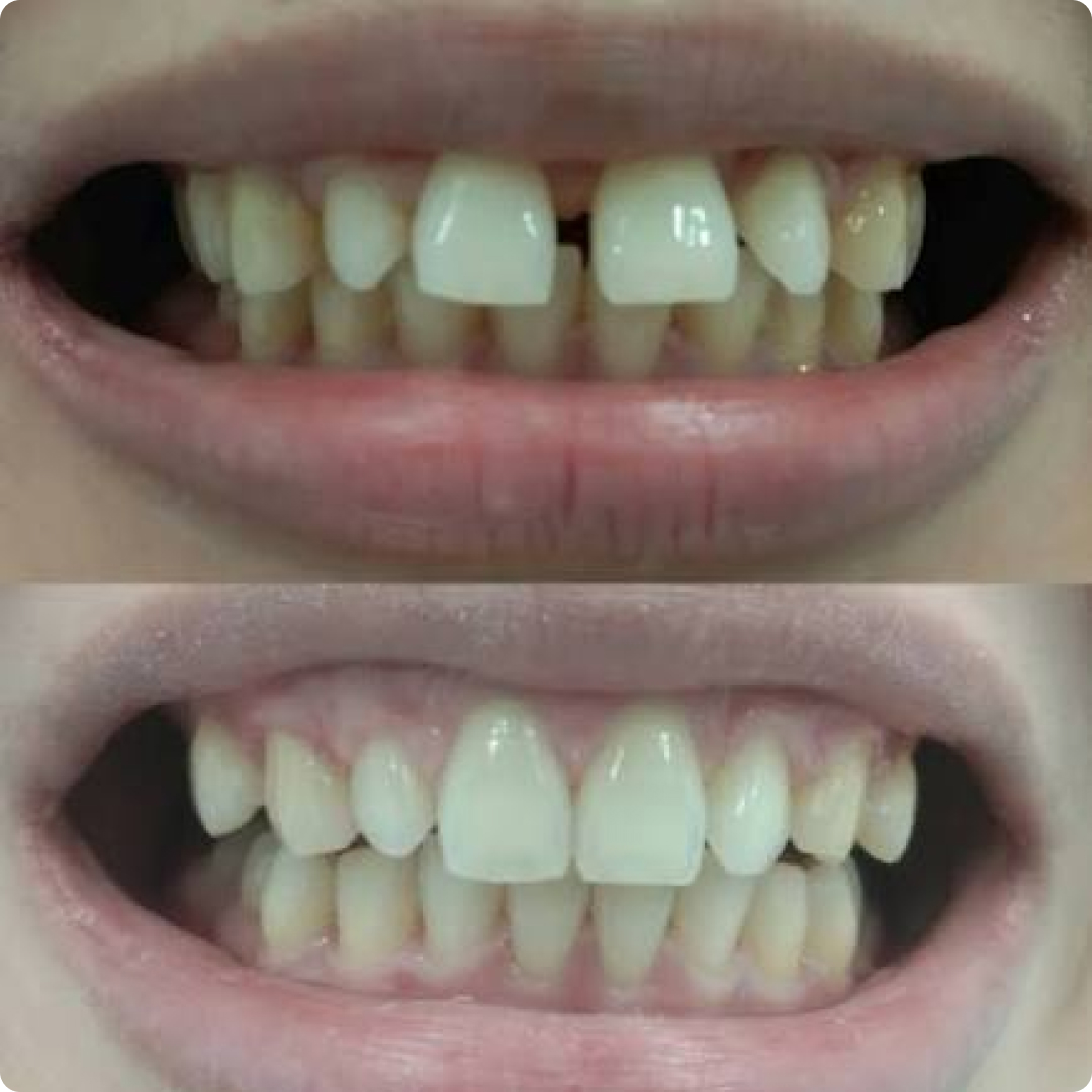 gigi jarang diastema