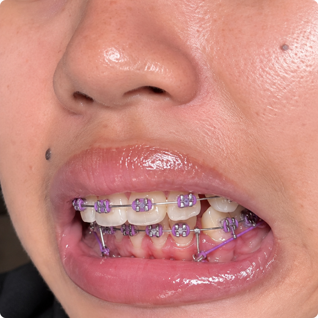 gigi jarang diastema