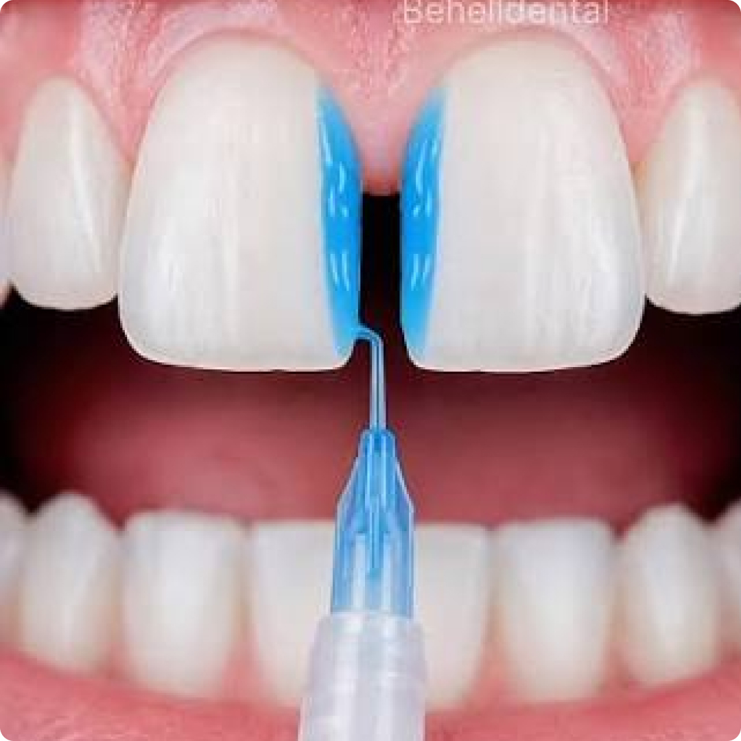 gigi jarang tengah diastema