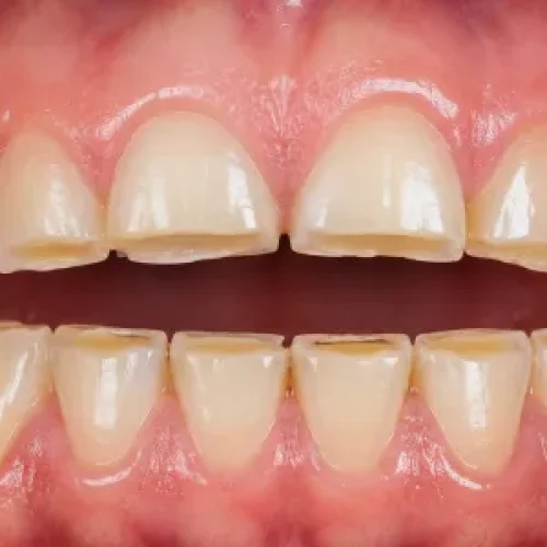 masalah gigi berkerat klinik pergigian kajang bangi aesira dental