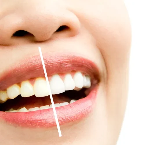 servis putihkah gigi di aesira dental